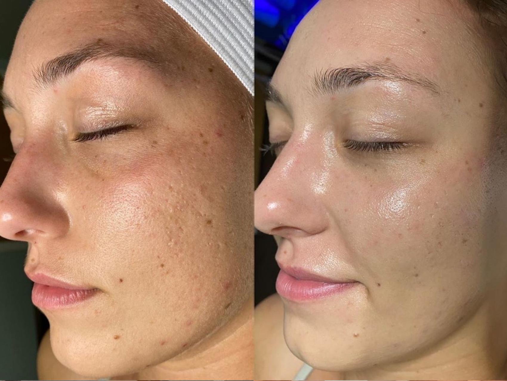 Hydrafacial Results