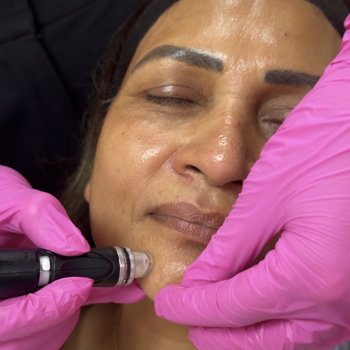 Hydrafacial Treatment
